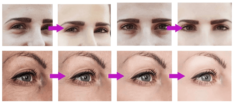 اسکرابر اولتراسونیک بخاردار برای پاکسازی پوست